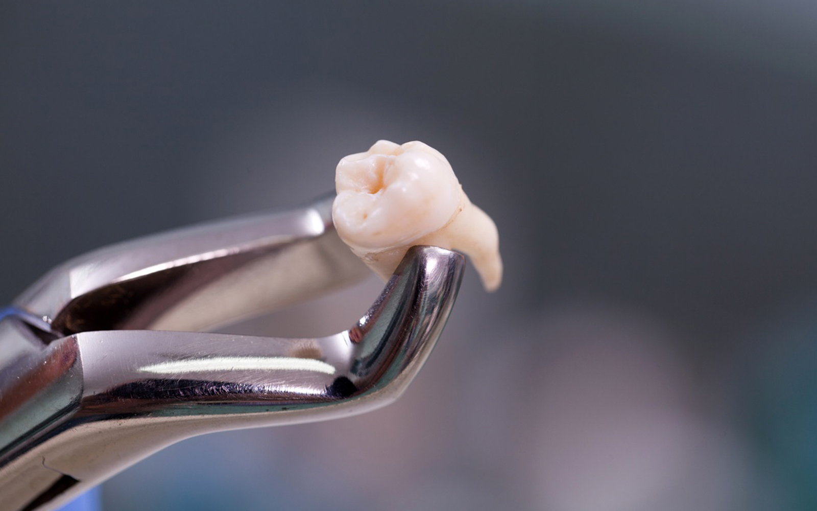 Bien se préparer à une intervention d’extraction de dents de sagesse… Dr